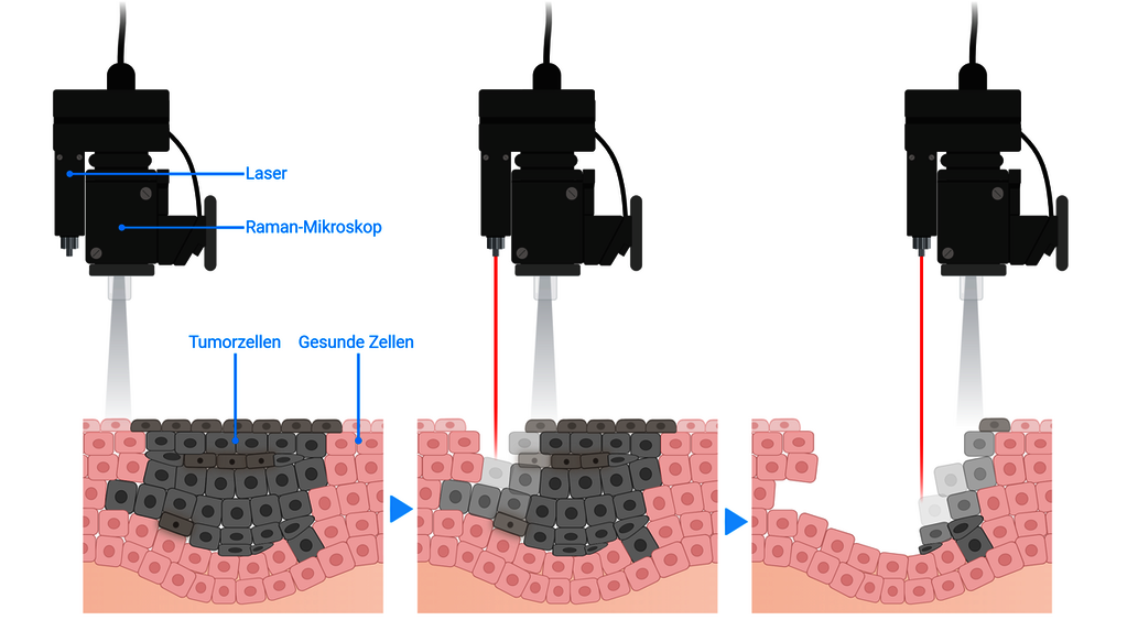 Das Mikroskop charakterisiert mithilfe von künstlicher Intelligenz das Tumorgewebe. Ein Laser zerstört daraufhin zielgenau die Krebszellen, während er das gesunde Gewebe verschont (Grafik erstellt mit Biorender.com). 